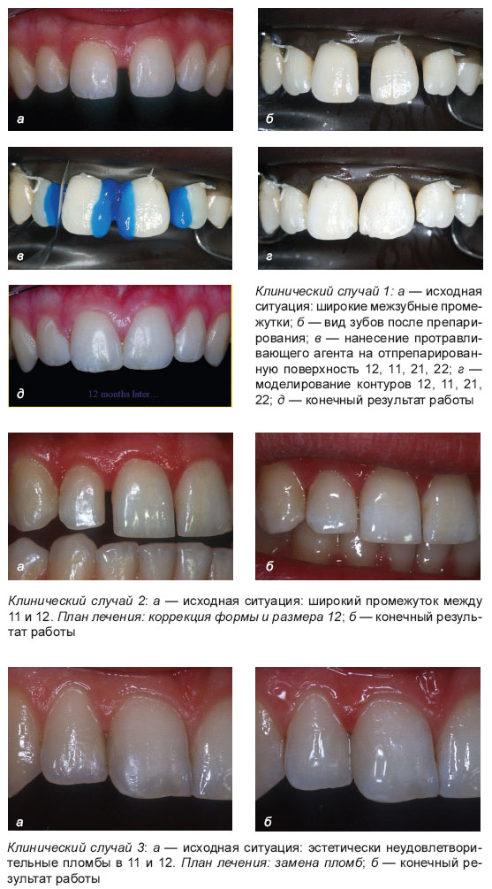 Композиционные материалы фирмы Heraeus Kulzer