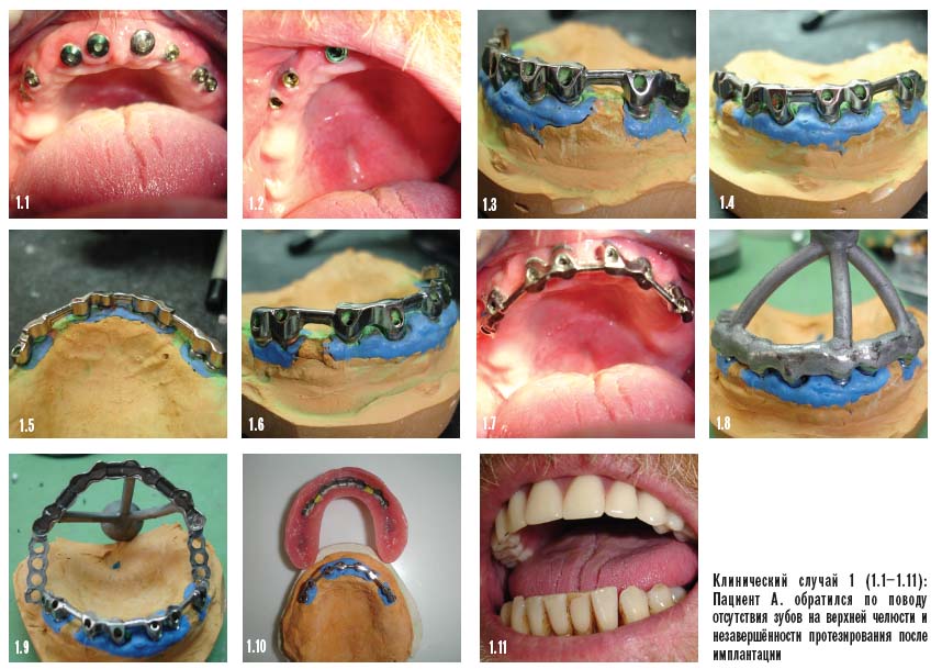 Протезирование зубов после имплантации. Клинический случай 1
