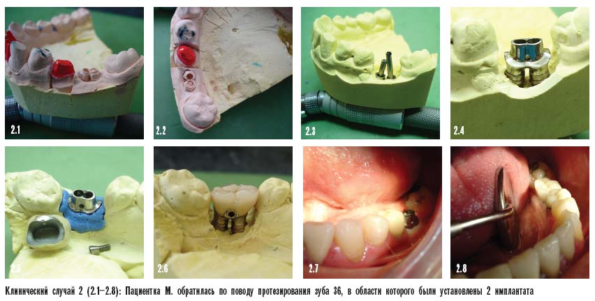 Протезирование зубов после имплантации. Клинический случай 2