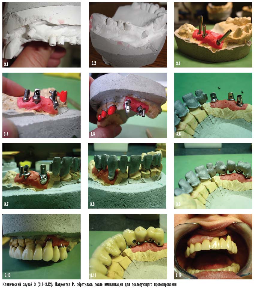 Протезирование зубов после имплантации. Клинический случай 3