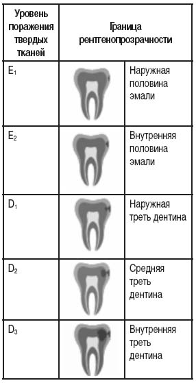 Рентгенологическая классификация проксимальных кариозных поражений по их глубине (Mejare I., 1999)