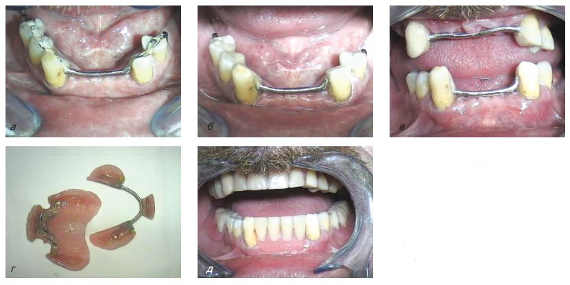 Протезирование пациентов с обширными включенными дефектами зубных рядов