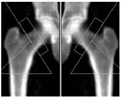 Денситограмма проксимального отдела бедренной кости
