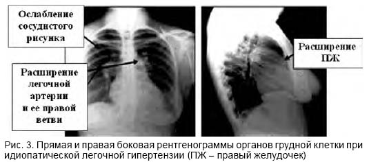 можно ли похудеть с акти вирным углем