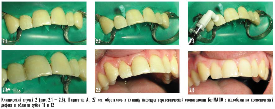 косметический дефект в области зубов
