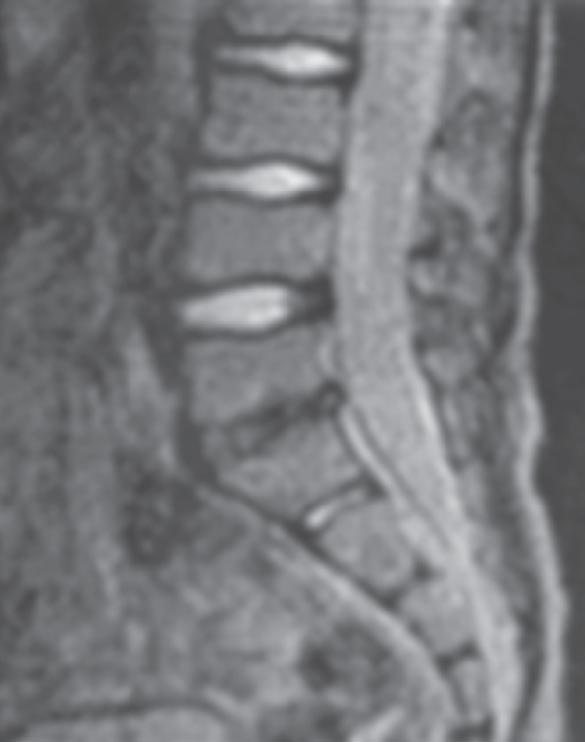 Рисунок 6. Пациент Г., 5,5 года. Диагноз: дисцит LV–S1. 6 мес от начала заболевания. МРТ пояснично-крестцового отдела позвоночника. Снижена интенсивность МР-сигнала на Т2-взвешенных сканах в диске LV–S1. Узурация смежных замыкательных пластинок тел LV и S1