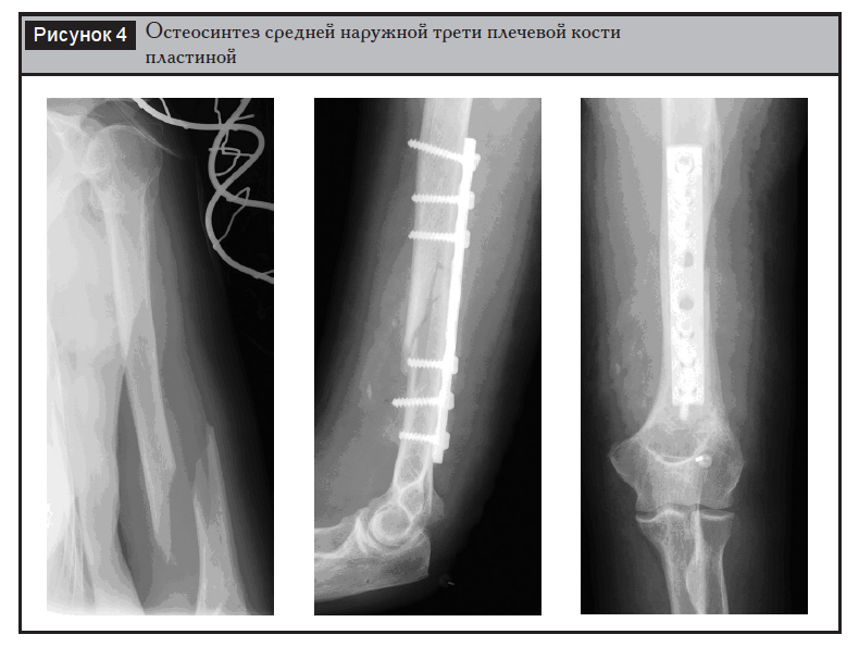 Лечение диафизарных переломов плечевой кости
